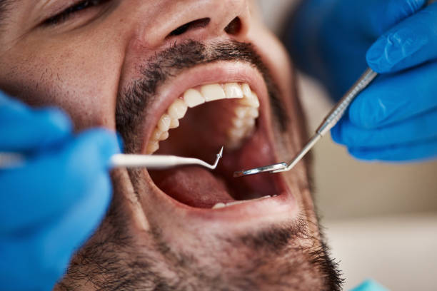 Best Emergency Wisdom Teeth Removal in Soh Ogden, UT